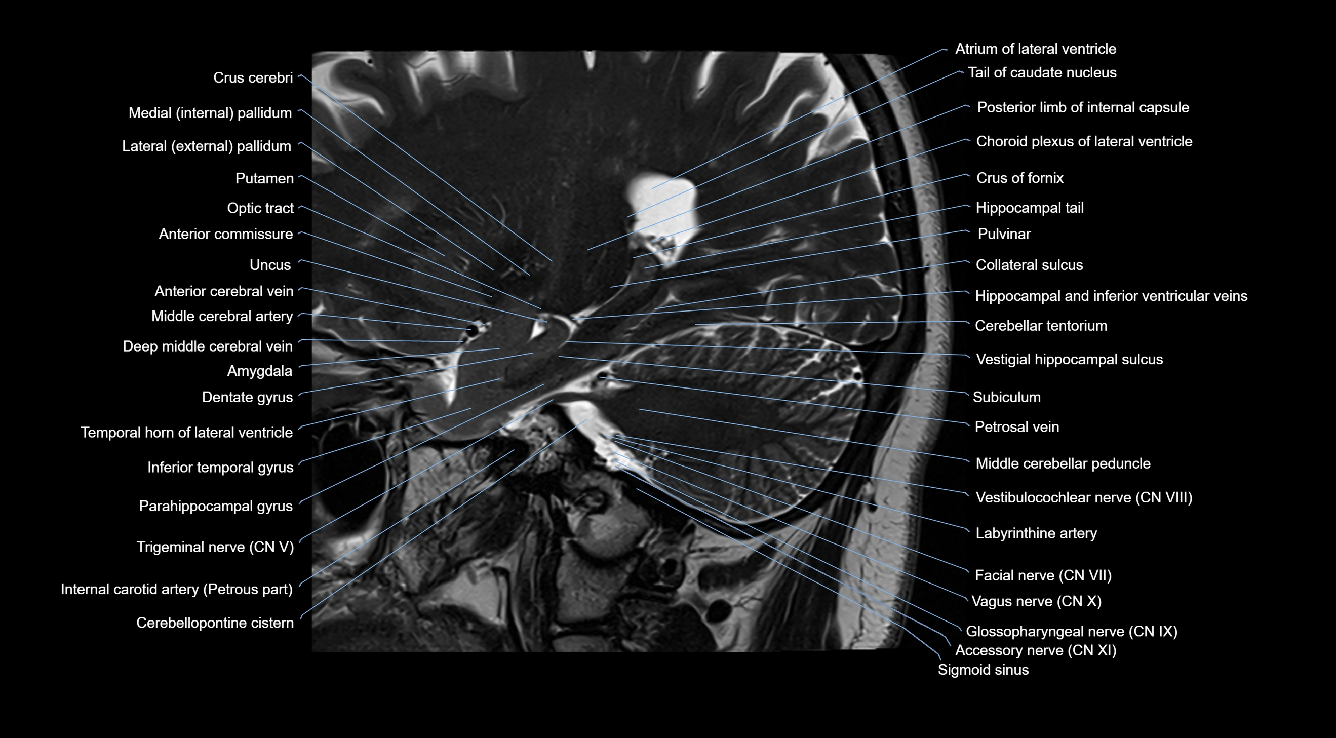 MRI brainstem & basal ganglia anatomy labelled  3T MRI images -img-10001-00015.webp